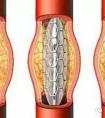 心臟支架國產(chǎn)的和進(jìn)口的有什么區(qū)別？